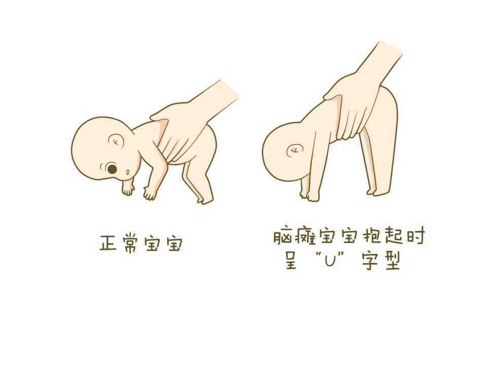 如何护理好脑瘫患儿呢?