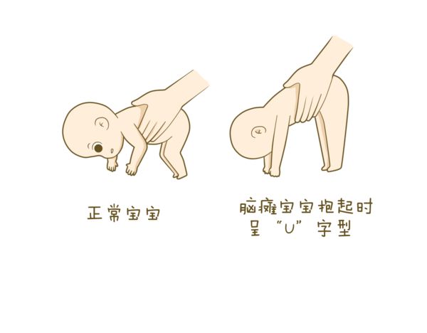 预防小儿脑瘫