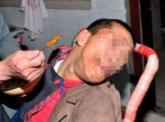 脑瘫的危害是哪些