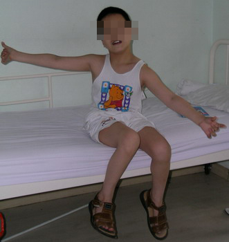 小儿脑瘫的发病征兆有哪些