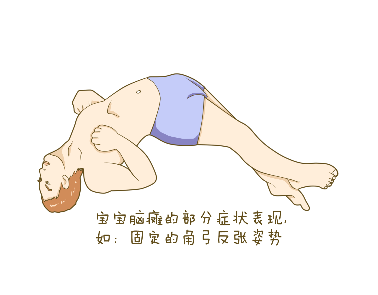脑瘫宝宝姿势异常有哪些表现